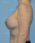 breast augmentation patient