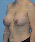 breast augmentation patient