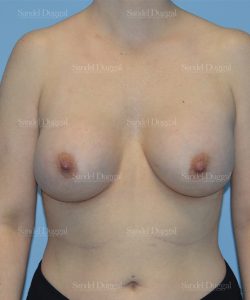 breast augmentation patient