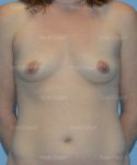 breast augmentation patient