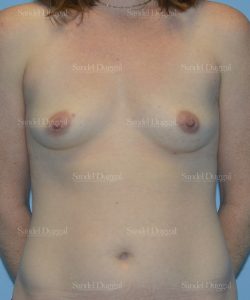 breast augmentation patient