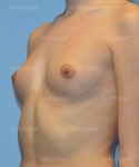 breast augmentation patient