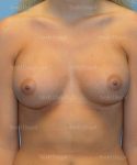 breast augmentation patient