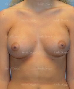 breast augmentation patient