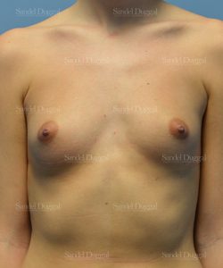 breast augmentation patient