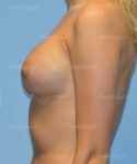 breast augmentation patient