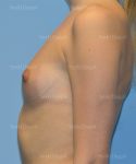 breast augmentation patient