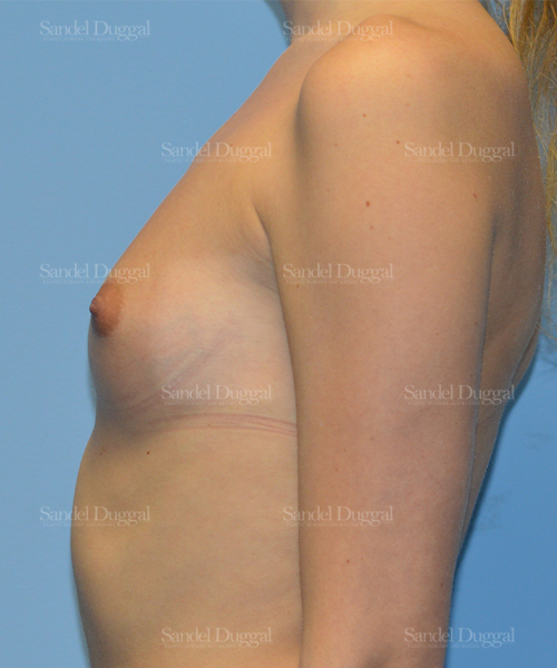 breast augmentation patient