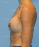 breast augmentation patient