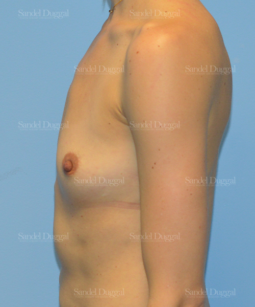 breast augmentation patient