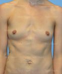 breast augmentation patient