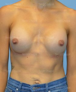 breast augmentation patient
