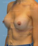 breast augmentation patient
