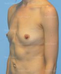 breast augmentation patient