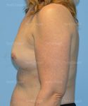 breast augmentation patient