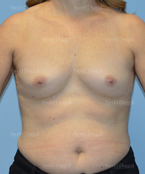 breast augmentation patient