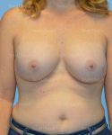 breast augmentation patient
