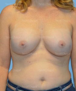 breast augmentation patient