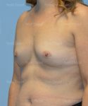 breast augmentation patient