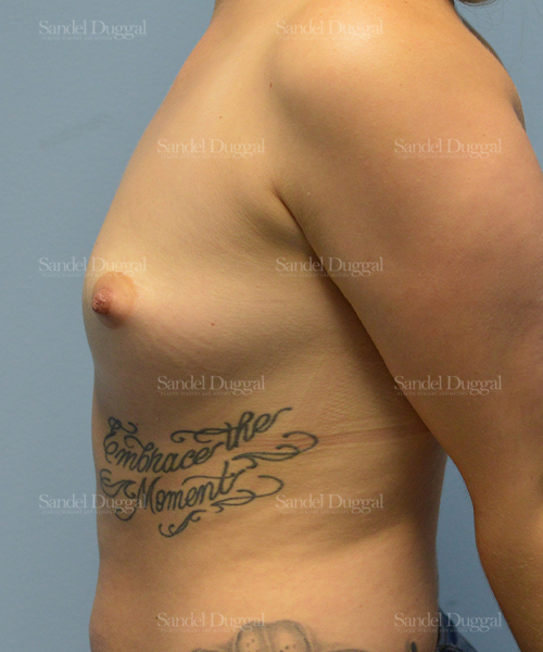 breast augmentation patient