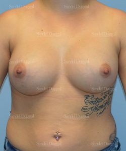 breast augmentation patient