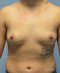 breast augmentation patient