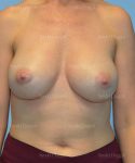 breast augmentation patient