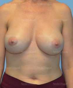 breast augmentation patient