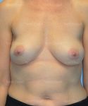 breast augmentation patient