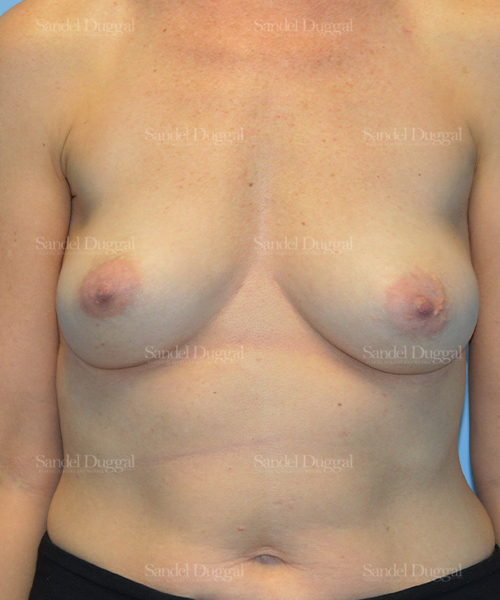 breast augmentation patient