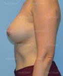 breast augmentation patient