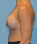 breast augmentation patient