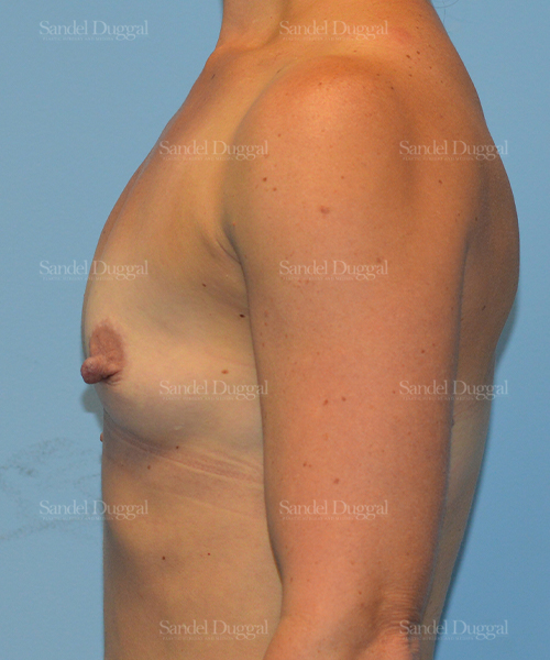 breast augmentation patient