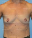 breast augmentation patient
