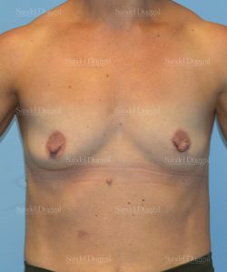 breast augmentation patient