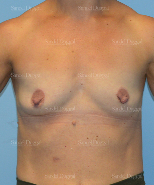 breast augmentation patient