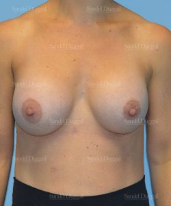 breast augmentation patient
