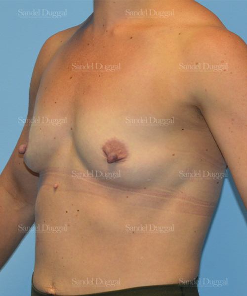 breast augmentation patient