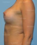 breast augmentation patient