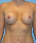 breast augmentation patient