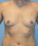 breast augmentation patient