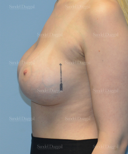 breast augmentation patient