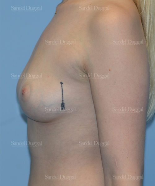 breast augmentation patient