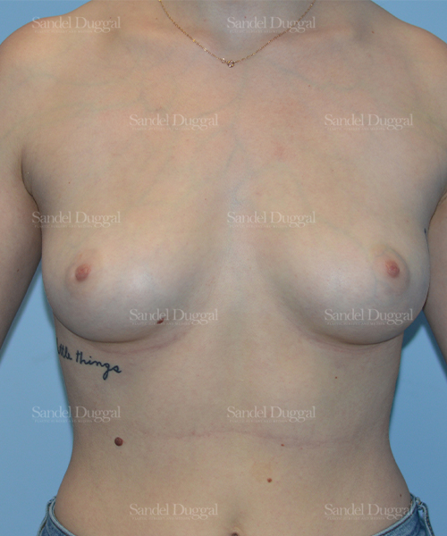 breast augmentation patient