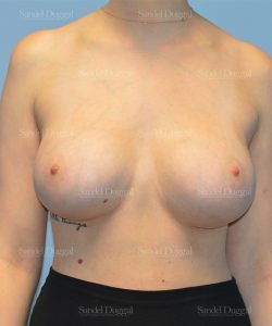 breast augmentation patient