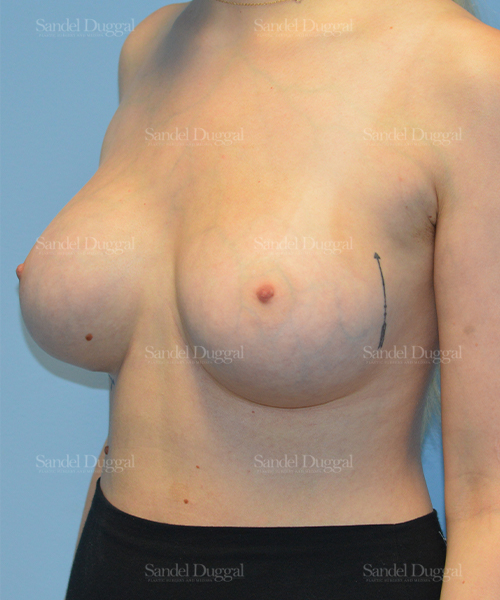 breast augmentation patient