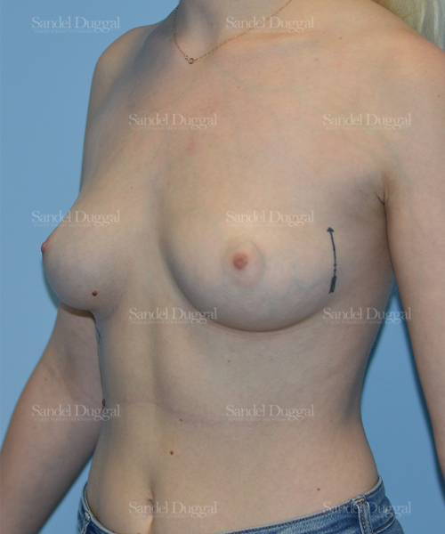 breast augmentation patient