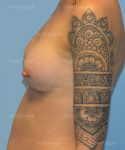 breast augmentation patient