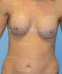 breast augmentation patient