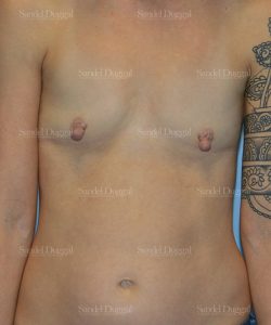 breast augmentation patient